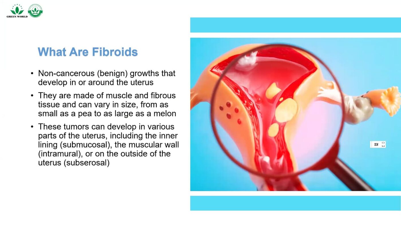 Illustration of a hand holding a model of the uterus showing fibroid growths