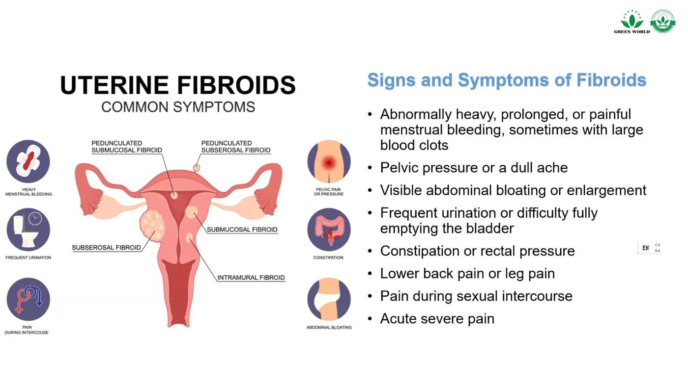 Infographic of common uterine fibroid symptoms including heavy bleeding, pelvic pressure and bloating