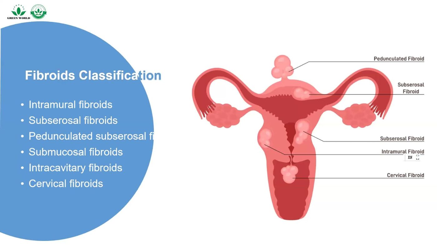 Diagram classifying fibroid types by location in the uterus